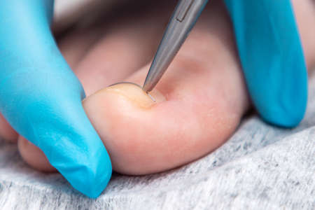 A podologist in blue gloves puts a titanium thread on a toenail. close-up. The concept of podology and chiropody.の写真素材