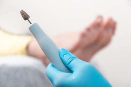 Chiropodist holding a handle of hardware peeling. Close up of female feet with ingrown toenails. The...
