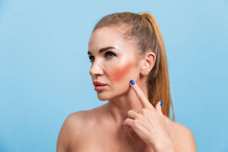 Portrait of a young Caucasian woman pointing to redness on her face. blue background. Rosacea concept.の写真素材