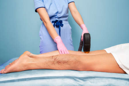 A cosmetologist does laser hair removal on woman's legs with varicose veins. Legs close-up. The concept of laser hair removal and varicose veins.の写真素材