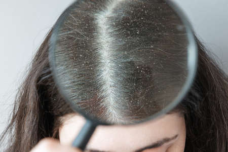 Doctor shows close-up of the parting of brunette hair on the head covered with dandruff. View through magnified glass. The concept of seborrheic dermatitis.の写真素材