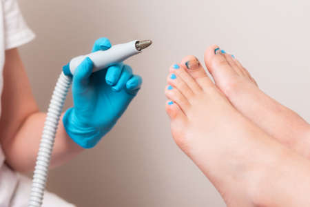 Chiropodist holding a handle of hardware peeling. Close up of female feet with ingrown toenails. The...