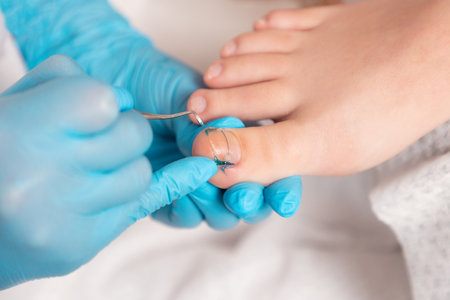 A podologist in blue gloves cleans a toenail with titanium thread. close-up. The concept of podology and chiropody.の写真素材
