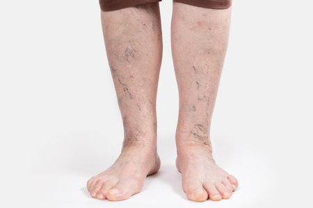 Varicosity and thrombosis. Close up of elderly feet of woman with vascular asterisks. white background. The concept of varicose veins.の写真素材