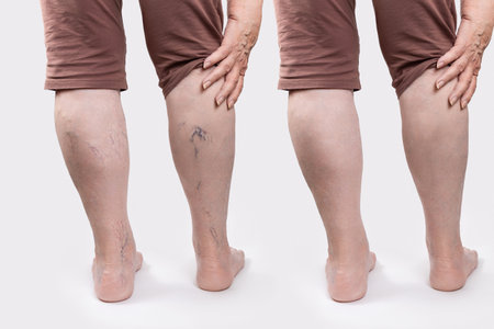 Varicosity. Close up of woman old legs with vascular asterisks. rear view. Results before and after laser treatment. white background. The concept of varicose veins.の写真素材