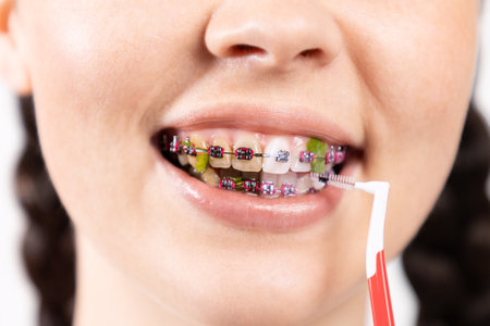 Close up of young Caucasian woman with brackets on dirty teeth cleaning interdental space using orthodontic toothbrushes. Before and after cleaning. Concept of dental care during orthodontic treatment.の写真素材