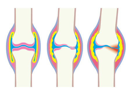 Joints, deformation, body, boneのイラスト素材