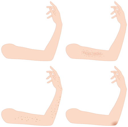 Arm. Spots. Stain. Blackhead.のイラスト素材
