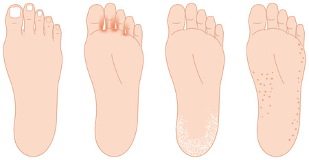 Troubles of the soles of the feet.のイラスト素材