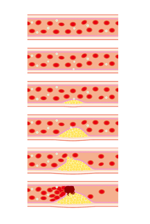 Image of vascular disease such as arteriosclerosisのイラスト素材