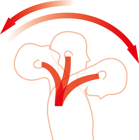 Movement of the neck due to impact from the back. Whiplash injury.のイラスト素材