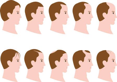 decrease in hair volume of men in profileのイラスト素材