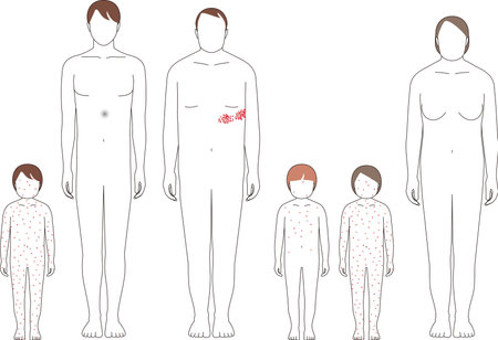 Shingles and chickenpox. Illustrations of symptoms in children and adultsのイラスト素材