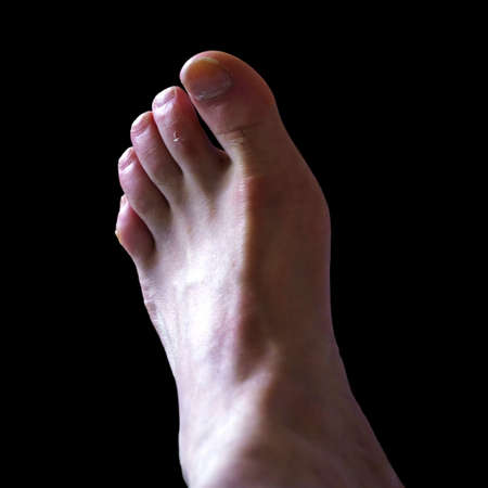 Men's foot with unkempt noggles and traces of injuries on a black background.