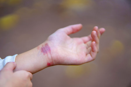 Baby's hand with thermal burns on the wrist