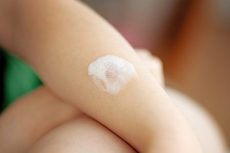 Teen's hand with minor thermal burn treated with medicinal pain-relief foam.の写真素材