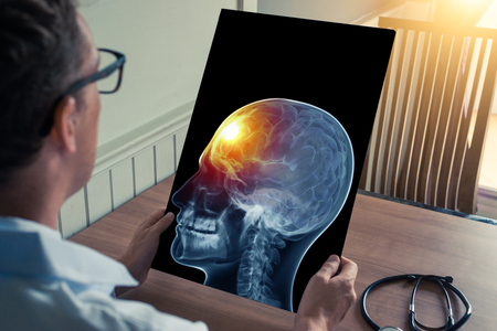 Doctor holding a x-ray of skull head with pain in the front of the brain in medical office. Headache migraine conceptの写真素材