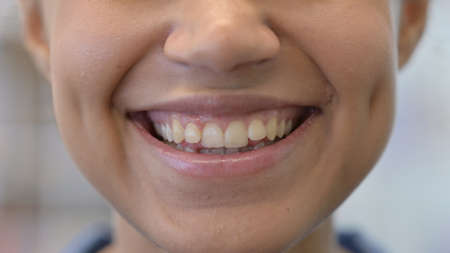 Close up of Mouth of African Woman with Toothache
