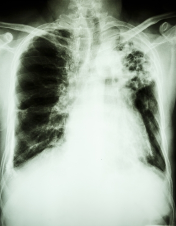 Film X-ray show patchy infiltrate at left upper lung from Mycobacterium tuberculosis infection  Pulmonary tuberculosis の写真素材