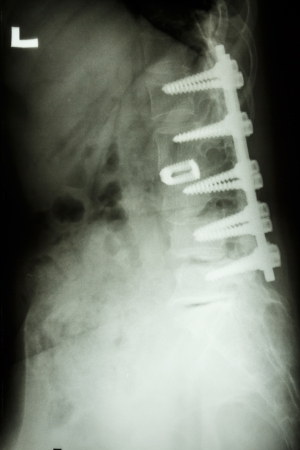 film X-ray show lumbar spine with pedicle screw fixation in spondylolithesis patientの写真素材
