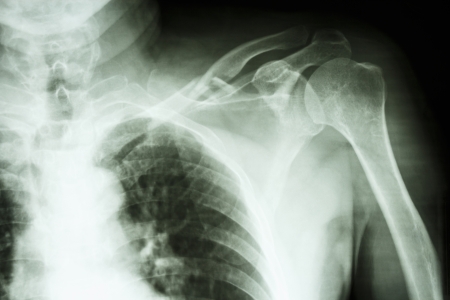 film X-ray show comminuted fracture middle one third left clavileの写真素材
