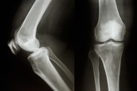 Film X-ray show normal knee joint AP Lateral の写真素材