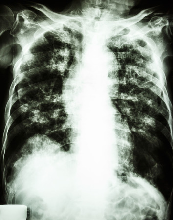 film chest x-ray show interstitial infiltrate and alveolar infiltrate both lung due to Mycobacterium tuberculosis infection  Pulmonary Tuberculosis の写真素材