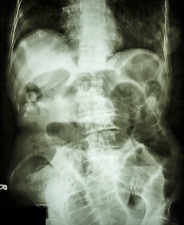 Film X-ray abdomen supine show small bowel dilated and air in small bowel due to small bowel obstructionの写真素材