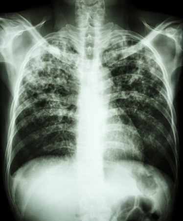  Pulmonary tuberculosis   Film chest x-ray show interstitial infiltration both lung due to mycobacterium tuberculosis infectionの写真素材