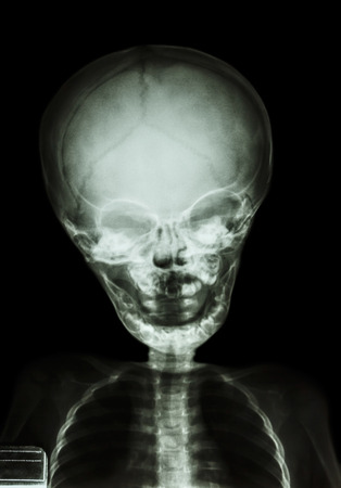 film x-ray skull and body of childの写真素材