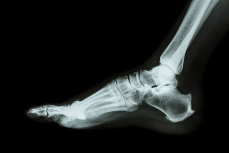 X-ray normal foot lateralの写真素材