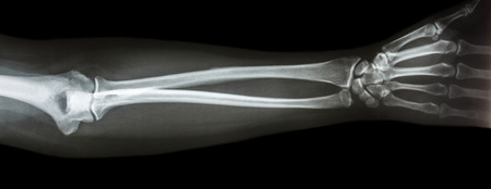 film x-ray forearm AP antero-posterior の写真素材