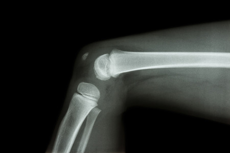 film x-ray knee lateral of childの写真素材