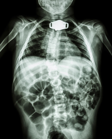 X-ray body of child and tracheostomy tube at neck area due to respiratory failureの素材 [FY31027474534]