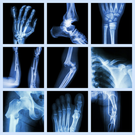 Collection of bone fractureの写真素材