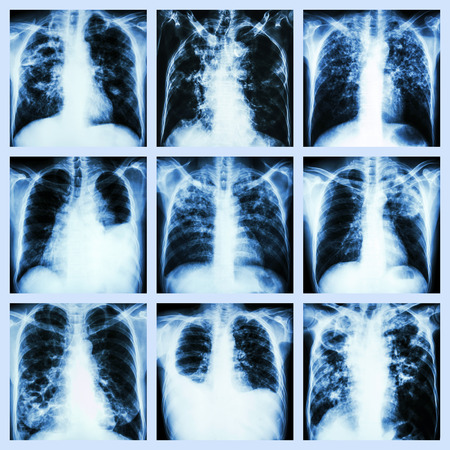 Collection of lung disease  Pulmonary tuberculosis,Pleural effusion,Bronchiectasis 