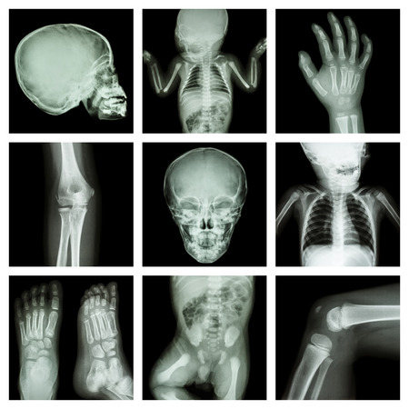 Collection x-ray part of child body  Version 2 