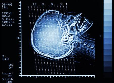 film CT scan  Computed tomography  brain   show section line on skullの写真素材