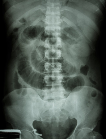 Small intestine obstruction  Film X-ray abdomen supine : Show small intestine dilate