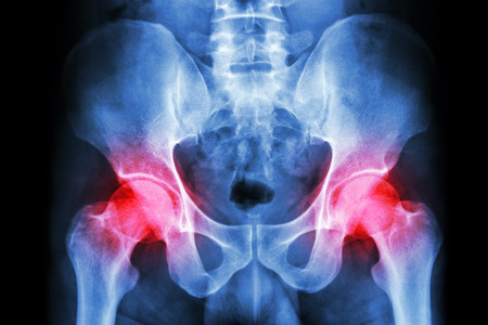 film x-ray human s pelvis and arthritis at both hip joint (Gout , Rheumatoid)の写真素材
