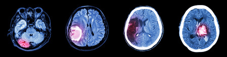 Collection CT scan of brain and multiple disease (Left to Right  :  Normal brain,Brain tumor,Cerebral infarction,Intracerebral hemorrhage)の素材 [FY31032098179]