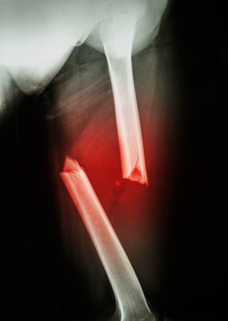 Film X-ray Left femur(left thigh) show complete fracture shaft of femur and displaceの写真素材