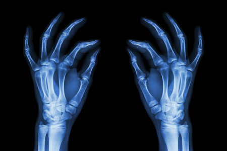 X-ray normal human hands (front) on black background