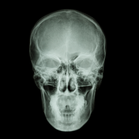 X-ray skull and Stroke ( cerebrovascular accident (CVA) )の写真素材