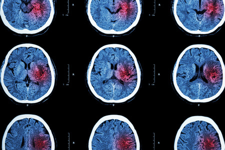 CT scan of brain with red area の写真素材