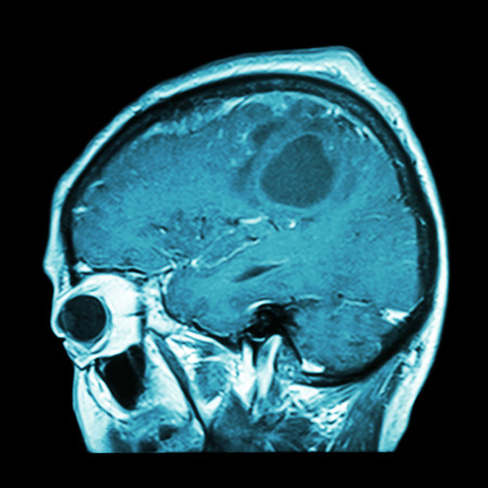 Film MRI of brain with brain tumor ( Sagittal plane , side view , lateral view ) ( Medical , Health care , Science Background )の写真素材