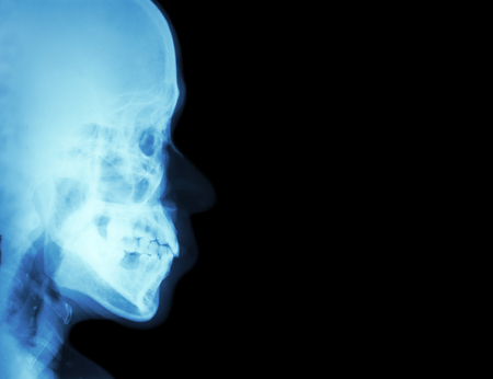 Film X-ray lateral nasal bone ( side view of skull ) and blank area at right side