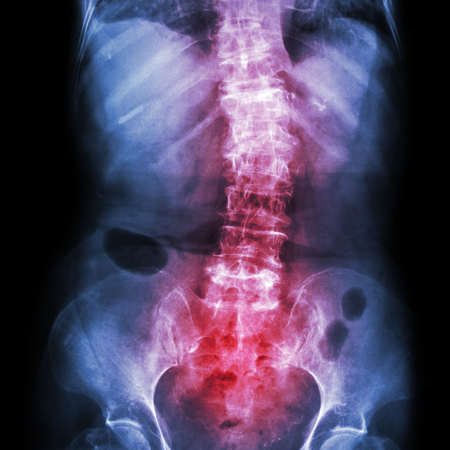 Spondylosis and Scoliosis ( film x-ray lumbar - sacrum spine show crooked spine ) ( old patient ) (...