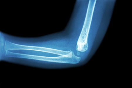 Film x-ray of child 's elbow ( normal child 's elbow ) ( Side view , Lateral )の写真素材