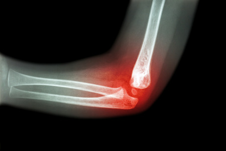 Rheumatoid arthritis , Gouty arthritis ( film x-ray child 's elbow with arthritis at elbow ) ( Side view , Lateral )の写真素材